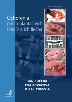 Ochorenia periimplanta�n�ch tkan�v a ich lie�ba