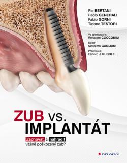 Zub vs. implant�t