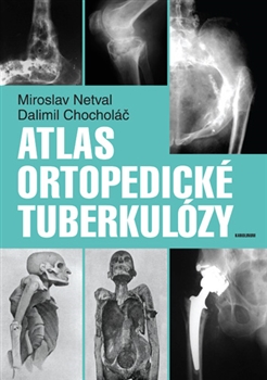 Atlas ortopedick� tuberkul�zy