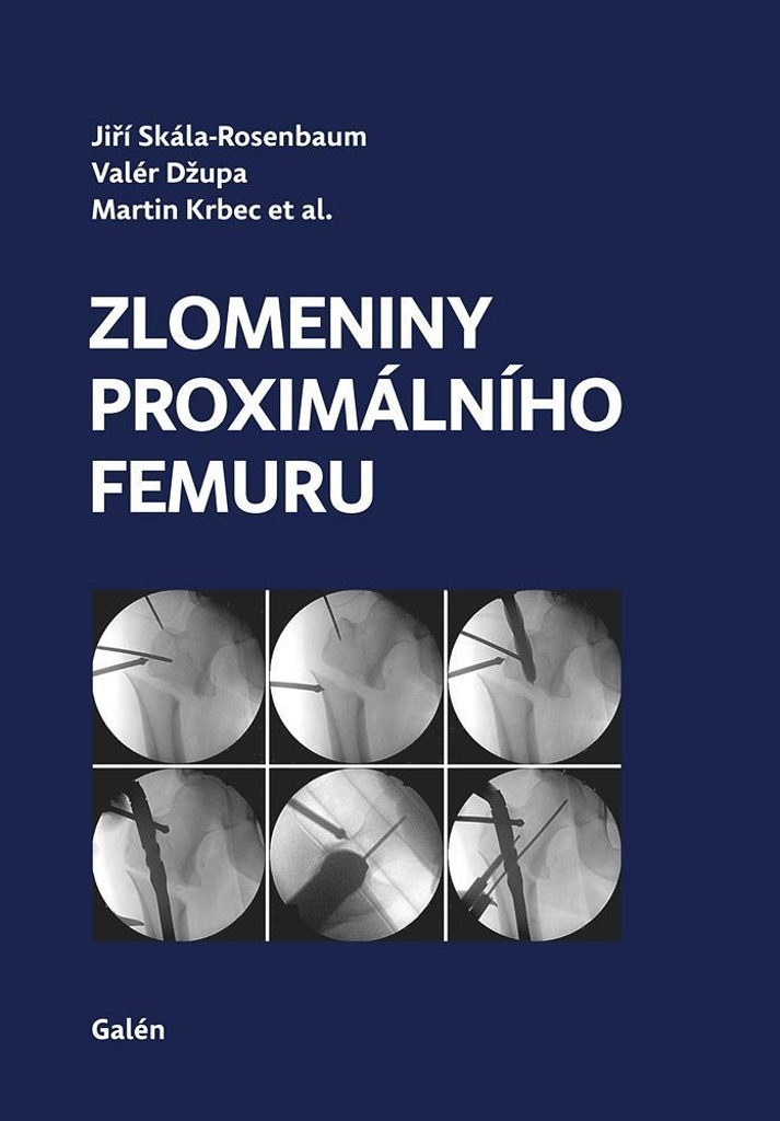 Zlomeniny proxim�ln�ho femuru