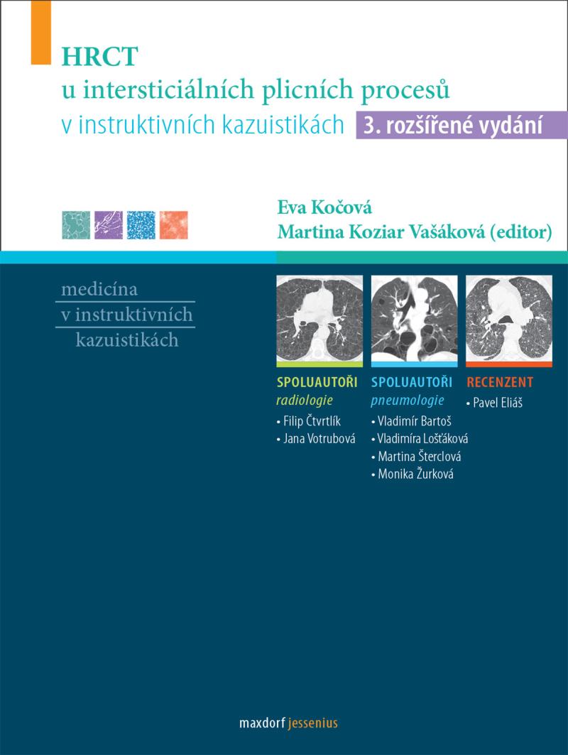 HRCT u interstici�ln�ch plicn�ch proces� v instruktivn�ch kazuistik�ch