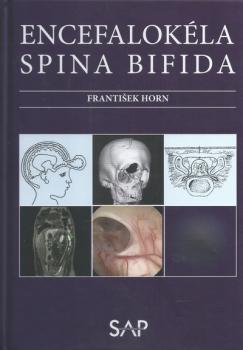 Encefalok�la spina bifida